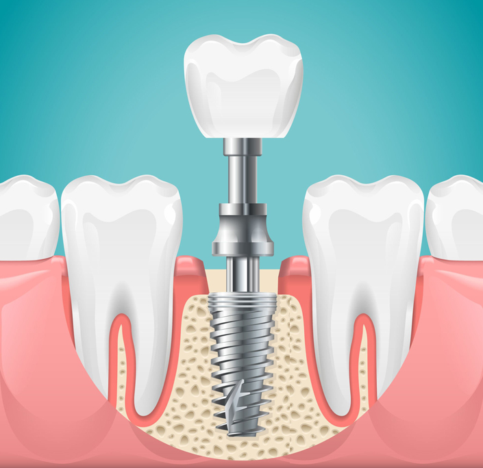Dental Fillings in Round Rock, TX - Chandler Creek Dental Care